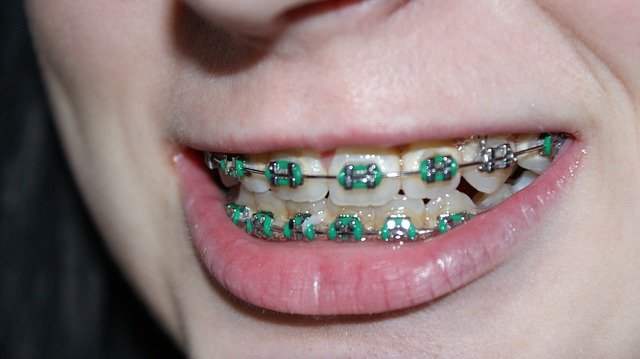 Advanced Options for Todays Braces 