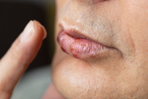 Why is Oral Herpes a Big Deal