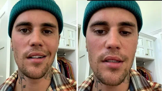 Justin Bieber More About Partial Face Paralysis and Ramsay Hunt Syndrome